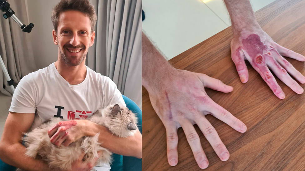 Así tiene las manos Romain Grosjean un mes y medio después del accidente que sufrió en el circuito de Shakir