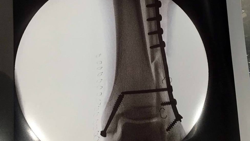 Radiografía de Tomás Campos en el que se aprecian los tornillos colocados sobre los huesos fracturados