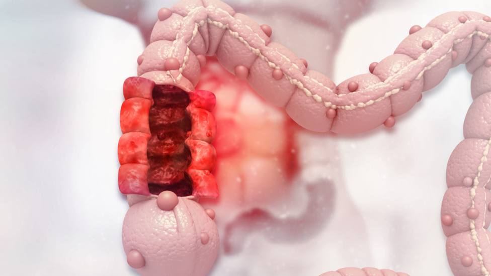 Médicos avisan: El cribado es vital para que el cáncer de colon sea curable en el 90% de los casos
