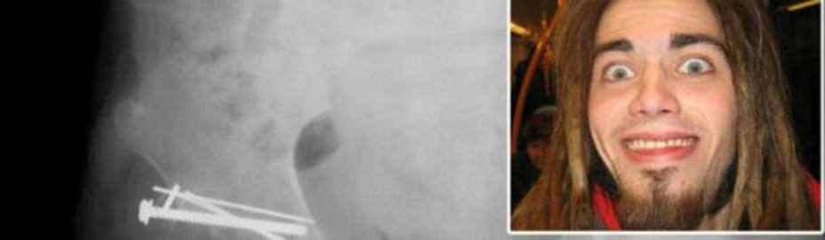Alexander Selvik Wengshoel y una radiografía de su cadera