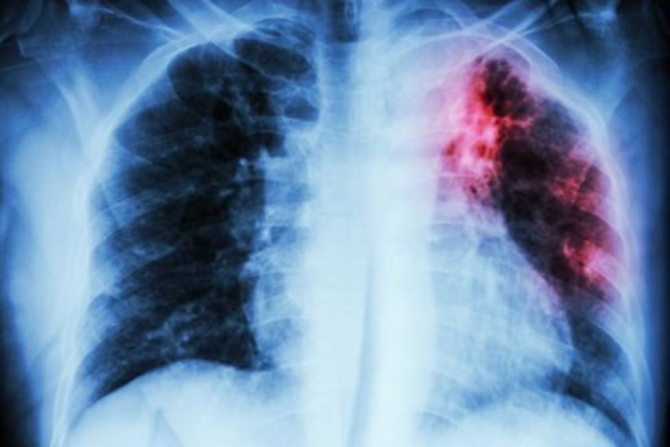 Los hospitales almerienses diagnostican cerca de 350 casos nuevos de cáncer de pulmón al año