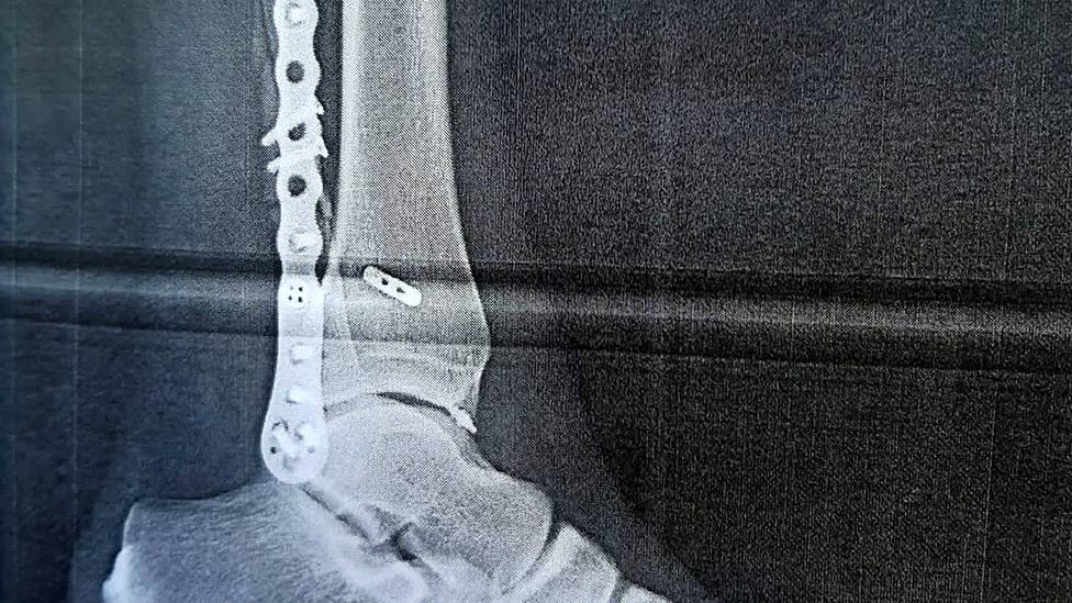 Radiografía de la zona lesionada en la pierna de Daniel Luque