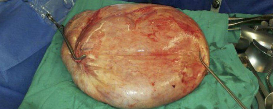 Este es el tumor extirpado de un ovario a una mujer de 47 años. EFE