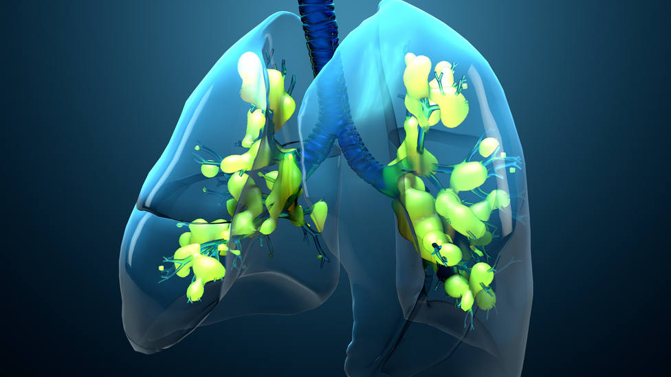 El síndrome de distrés respiratorio agudo es grave y potencialmente mortal