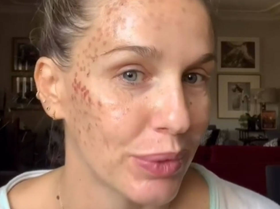 El agresivo tratamiento de belleza que ha afectado gravemente a la cara de la actriz Carola Baletzana
