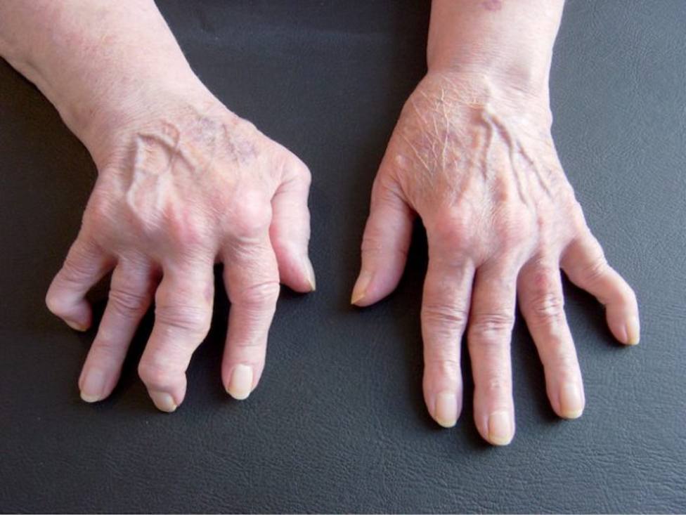 Qué le pasa a tu cuerpo cuando sufres artritis reumatoide