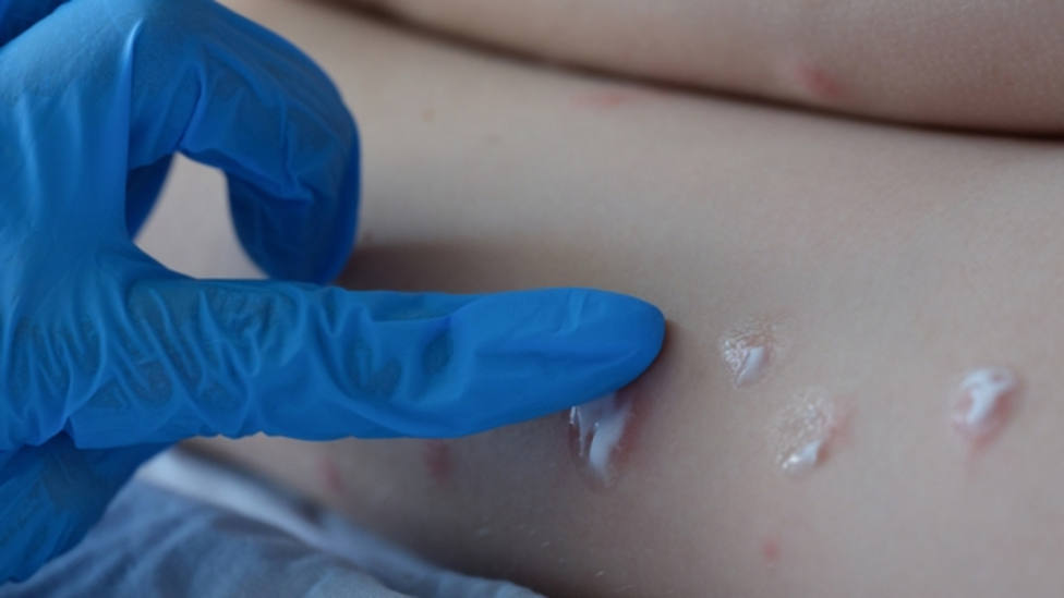 La vacuna de la viruela vuelve al candelero: ¿por qué dejaba señal en la piel?