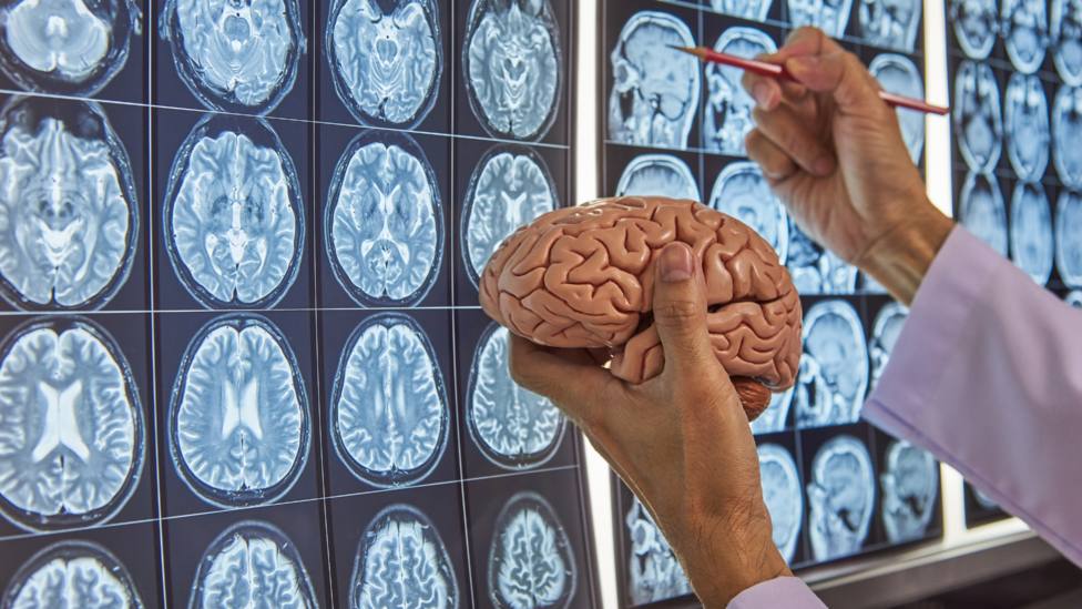 Alzhéimer: los cinco síntomas que podrían indicarte que padeces esta enfermedad, según expertos de Cambridge