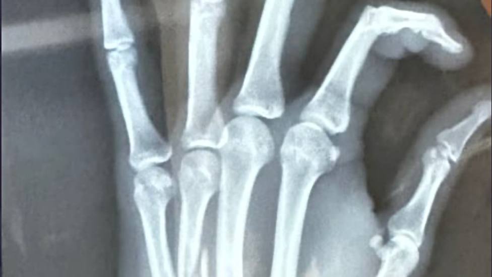 Detalle de la radiografía que muestra la lesión de Ginés Marín