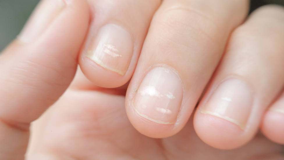 Un farmacéutico revela la verdadera razón por la que salen manchas blancas en las uñas