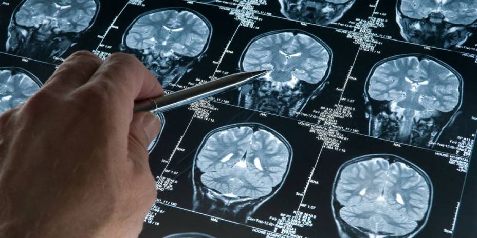 Logran detectar precozmente el Alzheimer en personas con Síndrome de Down