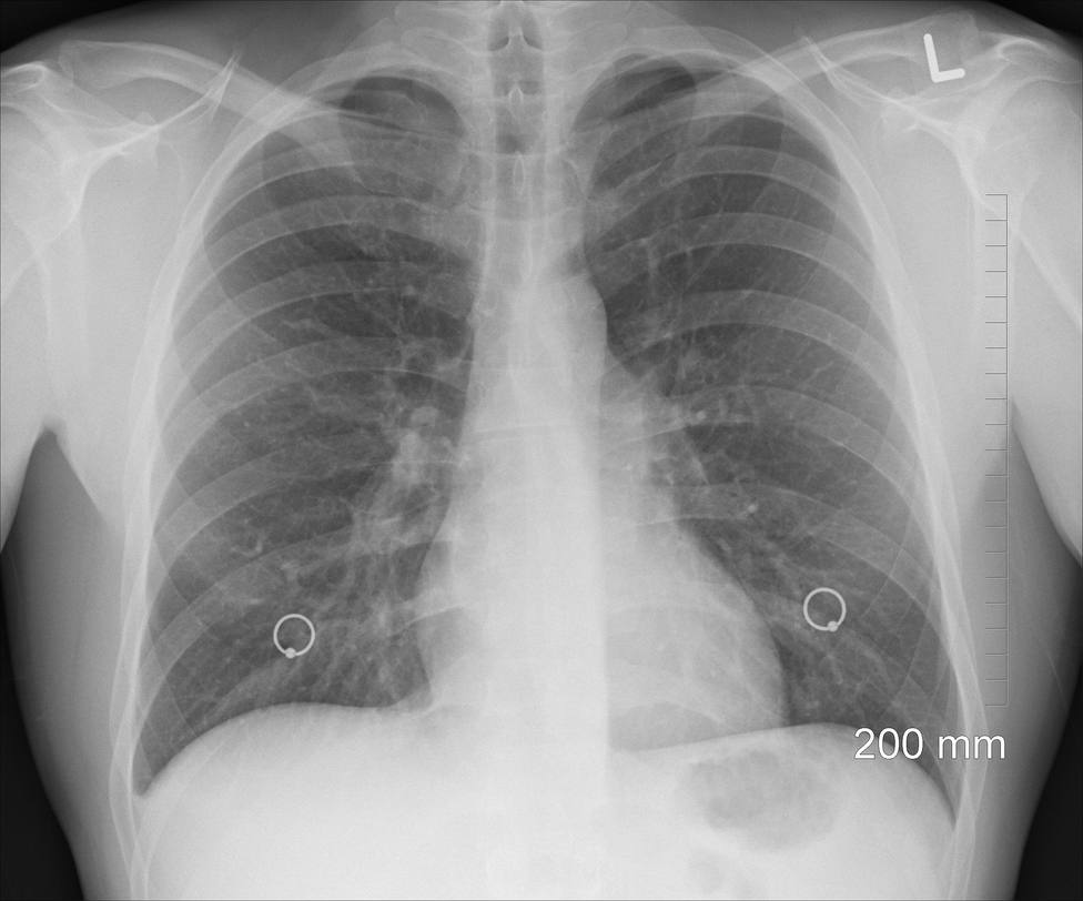 Pulmones, radiografia