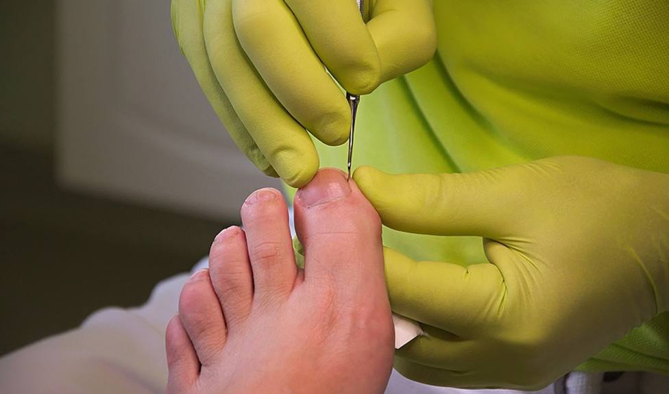 El 40% de las lesiones de pie diabético se pueden evitar con atención ambulatoria, según un informe