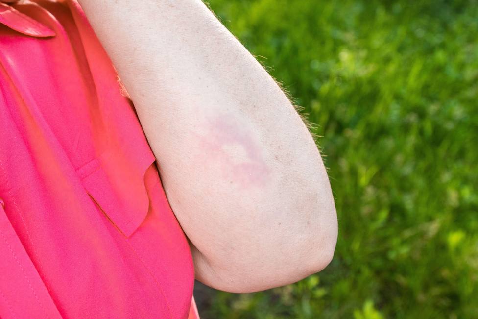 Una doctora revela el motivo por el que nos rascamos cuando pica un mosquito: Lo reconoce