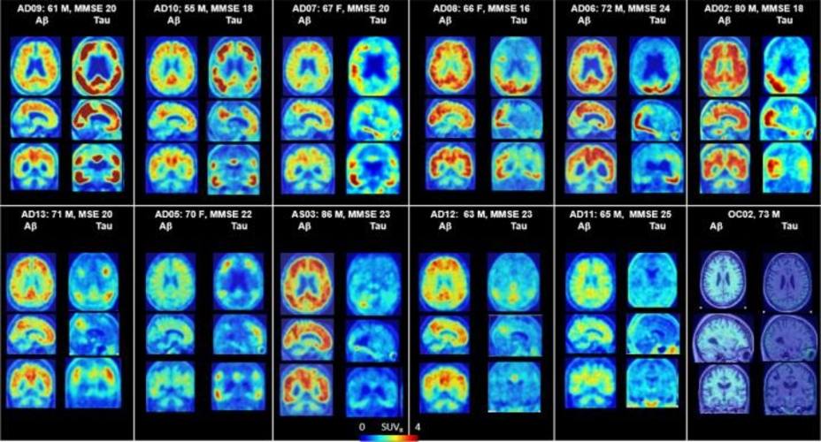 Investigadores identifican una prometedora herramienta diagnóstica del Alzheimer