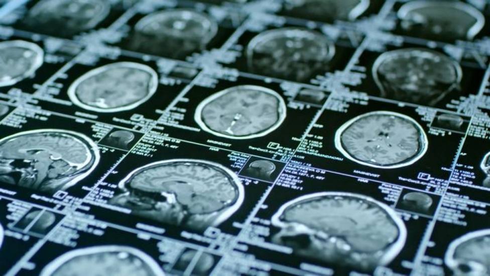 Identifican marcadores neurológicos en el cerebro que pueden detectar el riesgo de trastorno psicótico