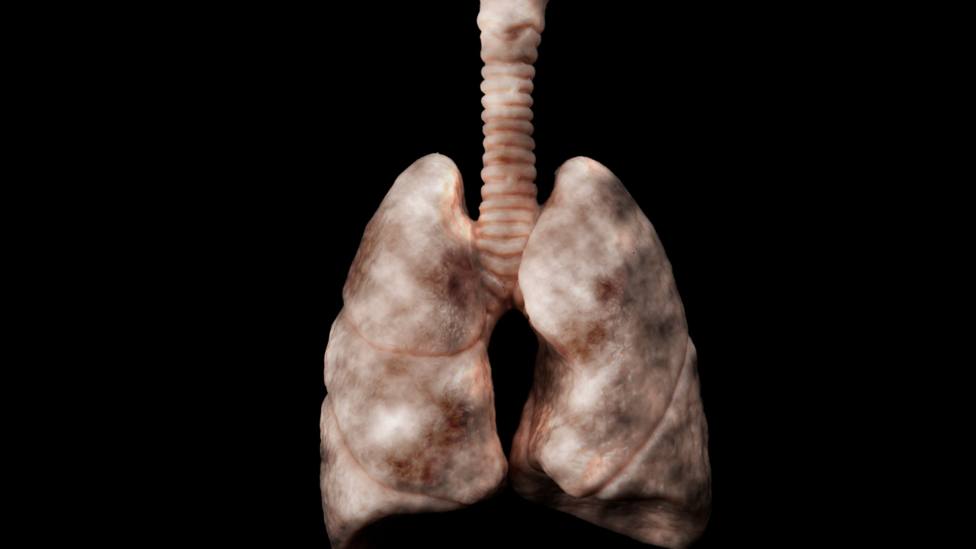 El cáncer de pulmón es uno de los mayores problemas de salud en el mundo