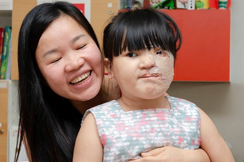 Éxito en los tratamientos y cirugías a una niña vietnamita con un tumor vascular facial