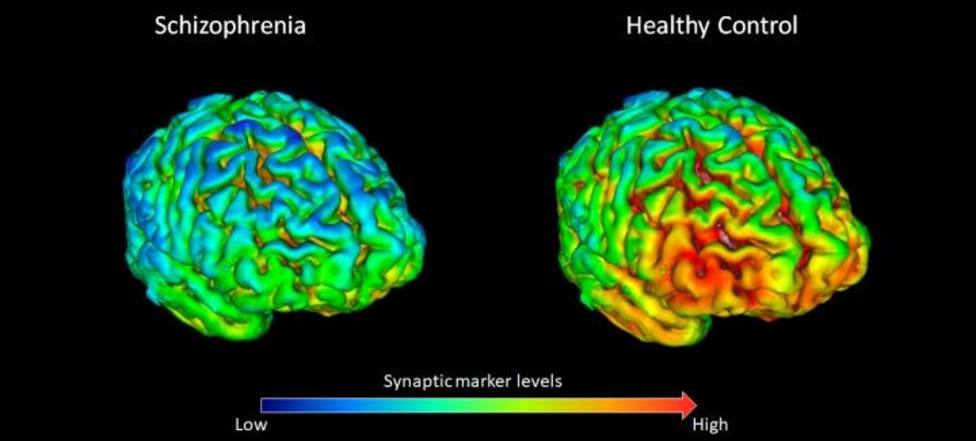 Un estudio prueba que los pacientes con esquizofrenia tienen menos conexiones cerebrales