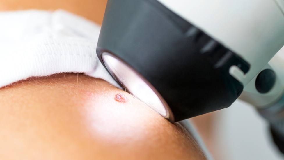 Es muy importante estar atento a las señales para descubrir el melanoma en nuestra piel