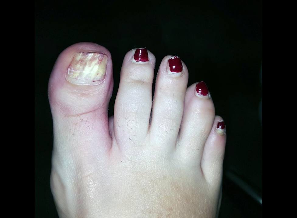 El exceso de esmaltes permanentes puede causar daños irreparables en las uñas de los pies
