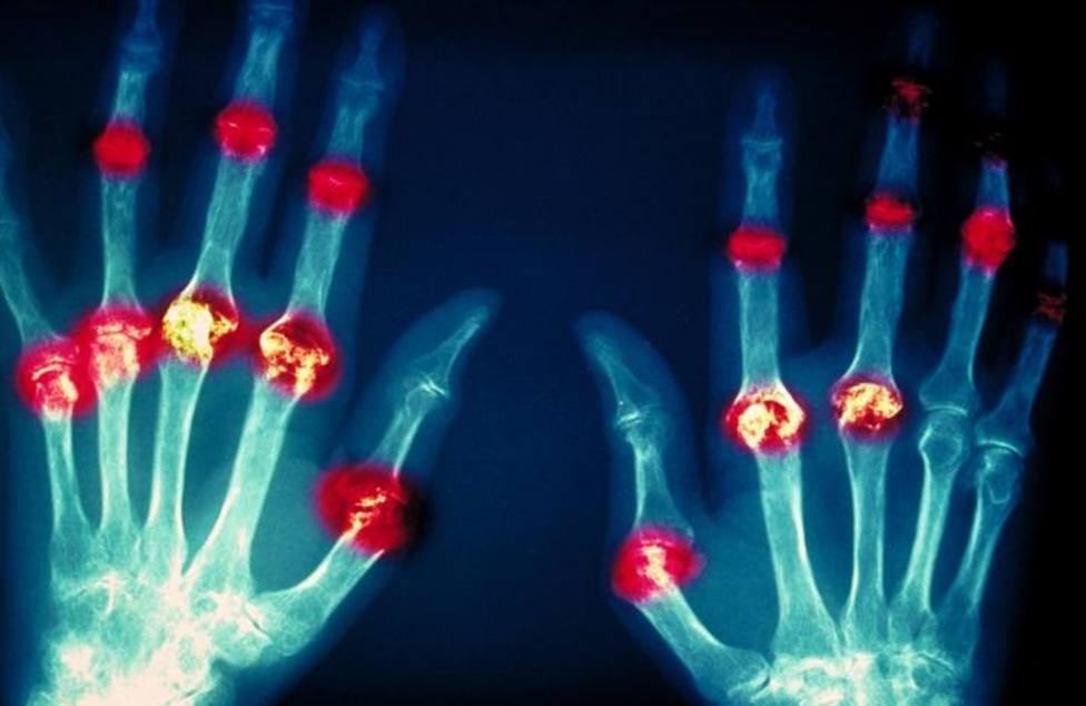 Investigadores avanzan en el conocimiento del daño tisular de la artritis reumatoide y el lupus eritematoso sistémico