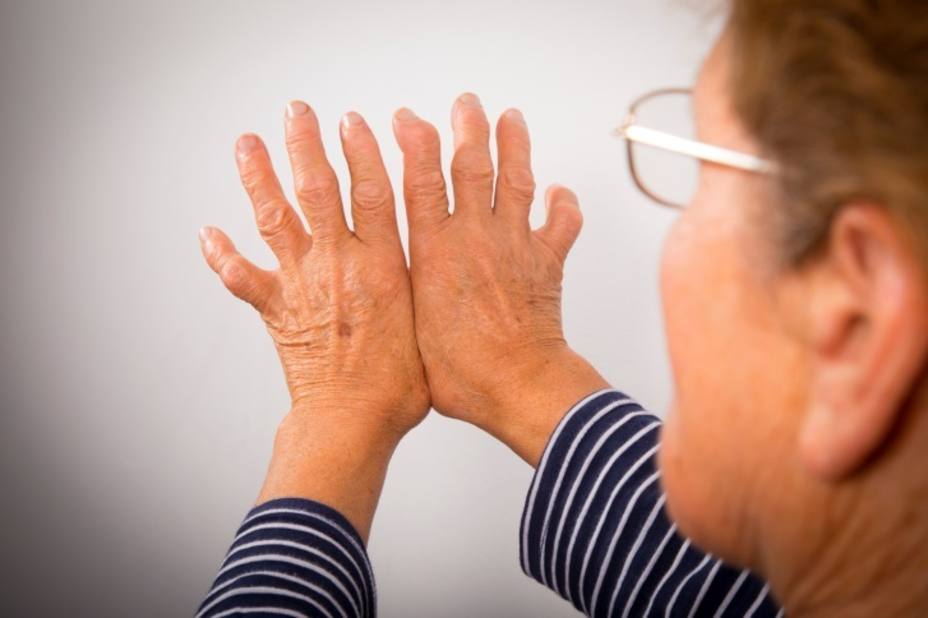 El 30% de los pacientes con artritis reumatoide padece enfermedad pulmonar intersticial
