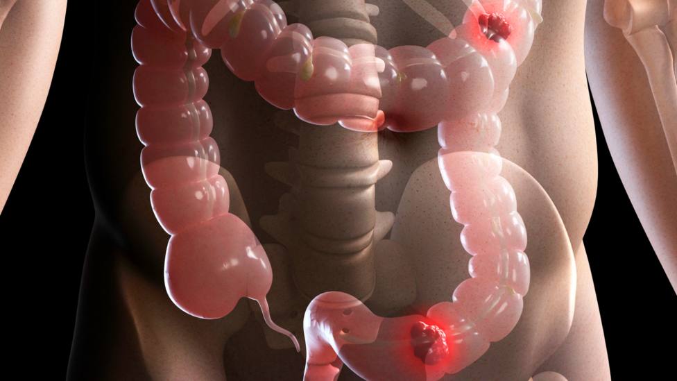 Detecta a tiempo el cáncer de colon: estos son los tres síntomas que deben ponerte en alerta