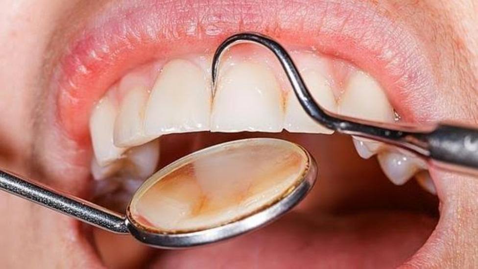 Cómo diferenciar una llaga en la boca de una úlcera cancerígena: un médico cuenta cuándo preocuparse
