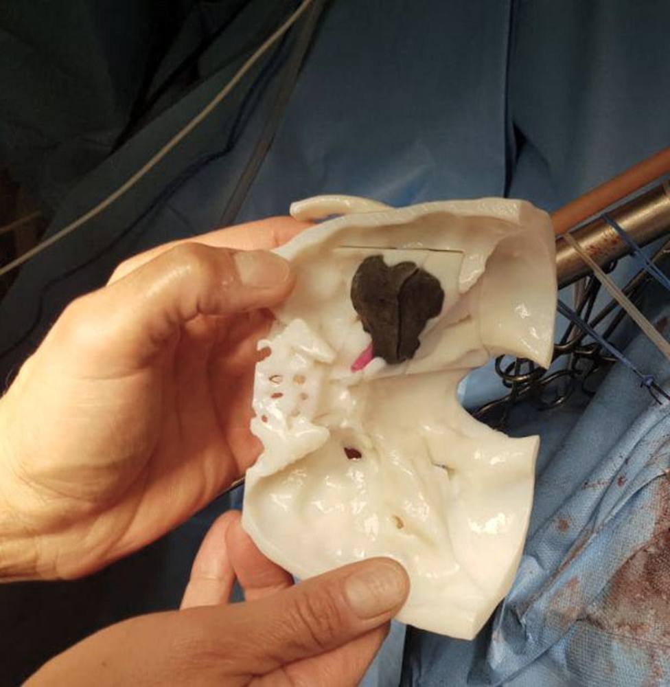 La utilización de biomodelos digitales 3D es clave para la planificación quirúrgica en neurocirugía