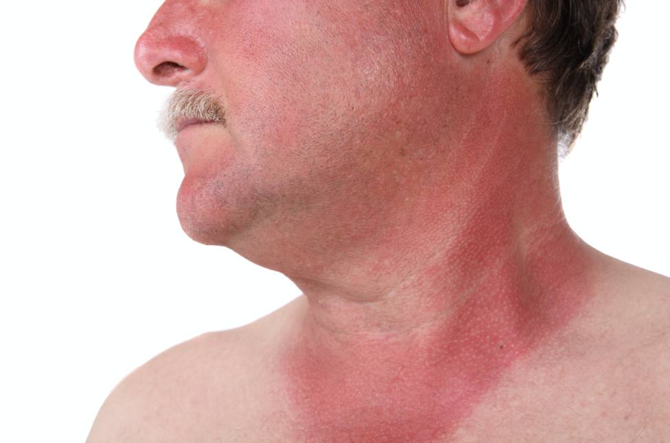 La Skin Cancer Foundation advierte que las quemaduras solares dañan nuestra piel en muchos sentidos