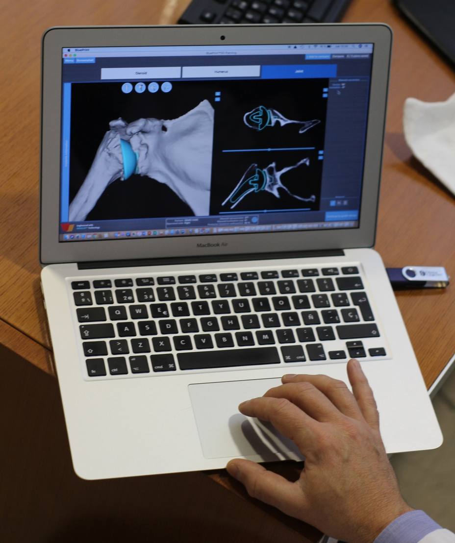 Un programa de cirugía virtual mejora la función, movilidad y resultado de las prótesis de hombro