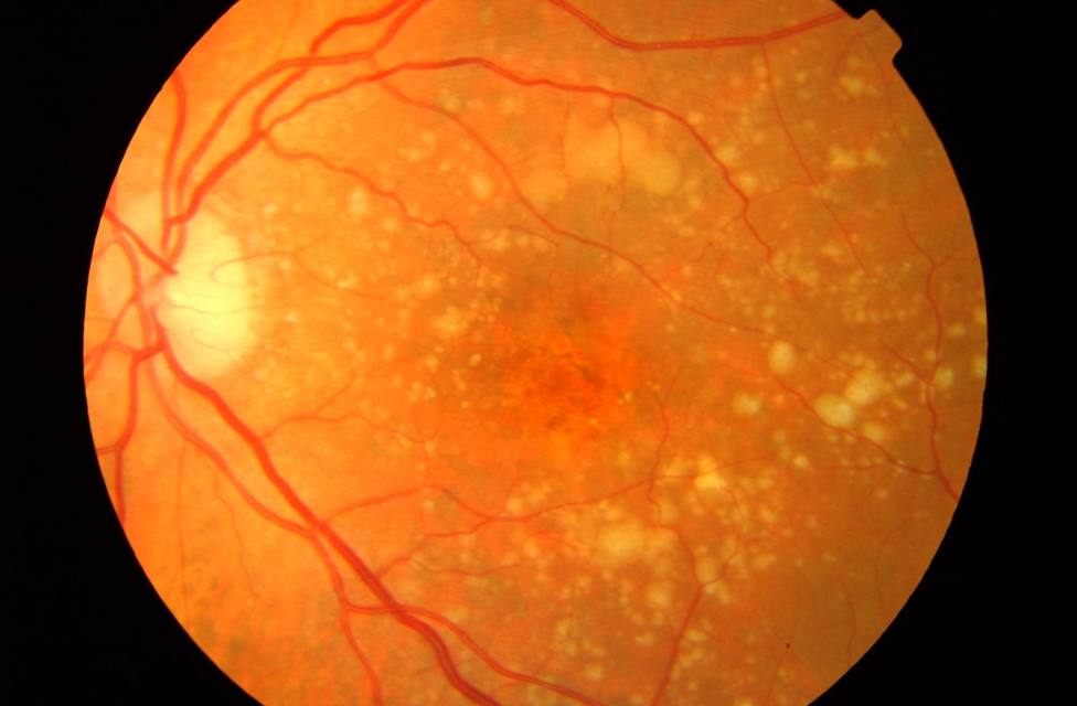Prevenir, enlentecer y regenerar la retina en la DMAE, principales líneas de investigación sobre la enfermedad