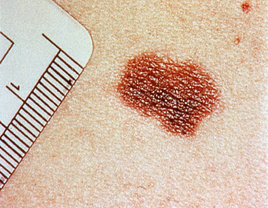 Sólo uno de cada cuatro melanomas aparece sobre un lunar del cuerpo