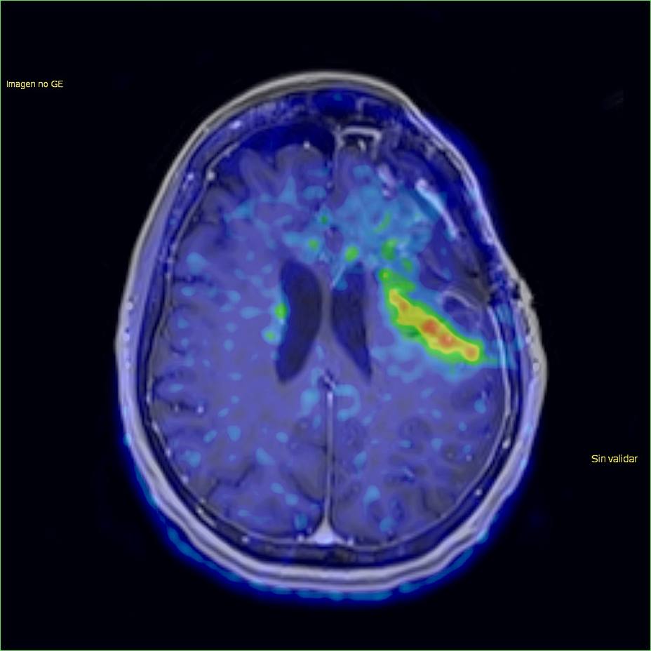 Un estudio muestra potencial para desarrollar biopsias líquidas de tumores cerebrales