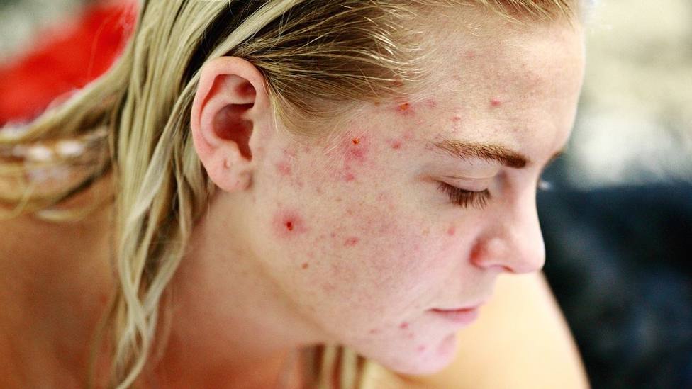 Estos son los tres trucos para evitar la aparición de acné en la cara para siempre