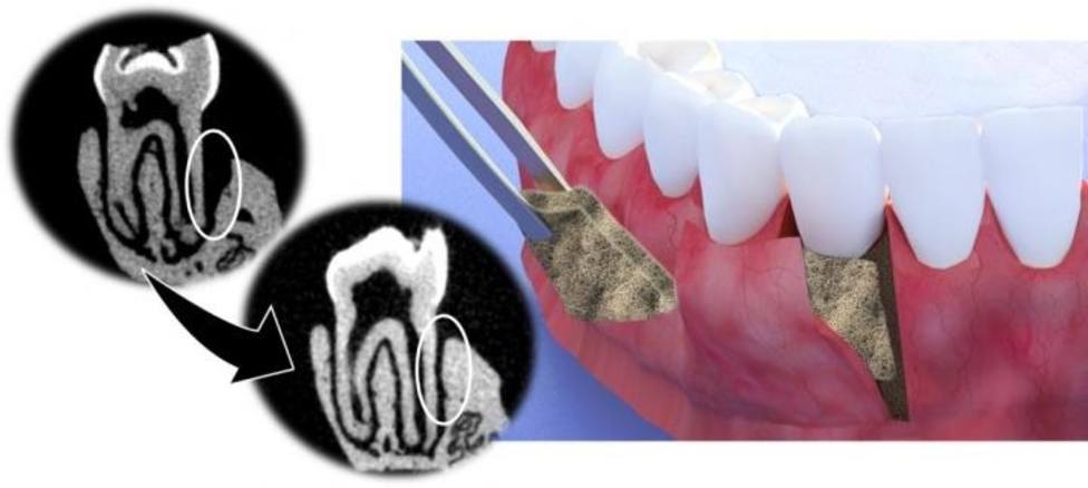 Investigadores crean una membrana que ayuda a regenerar tejido periodontal de las encías