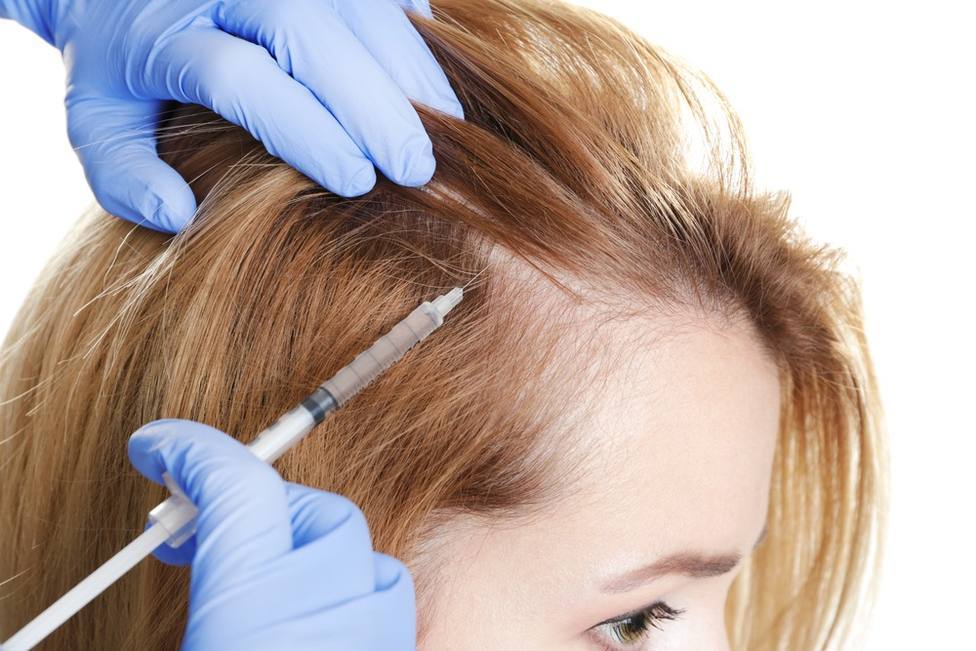 Alopecia en mujeres: Estos son los mejores tratamientos para evitarla