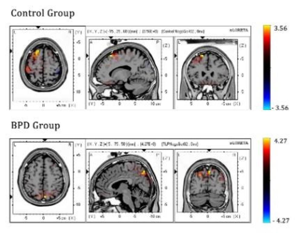 Estudio muestra que se activan regiones cerebrales distintas para controlar impulsos en trastorno límite de personalidad
