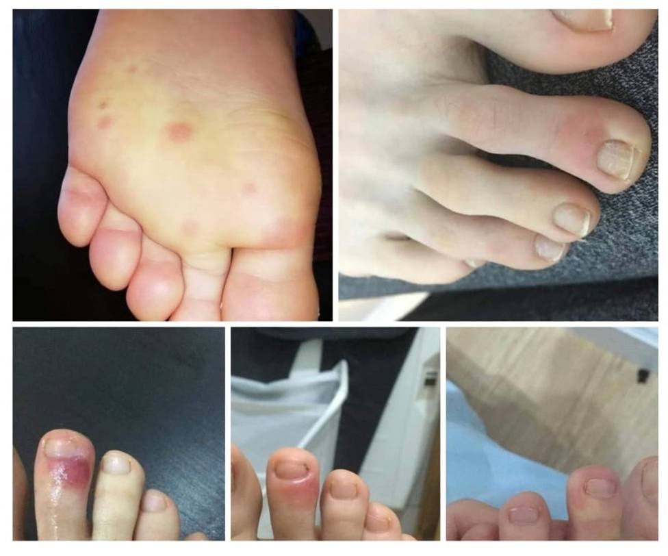 Niños y adolescentes contagiados de COVID-19 presentan erupciones en los pies